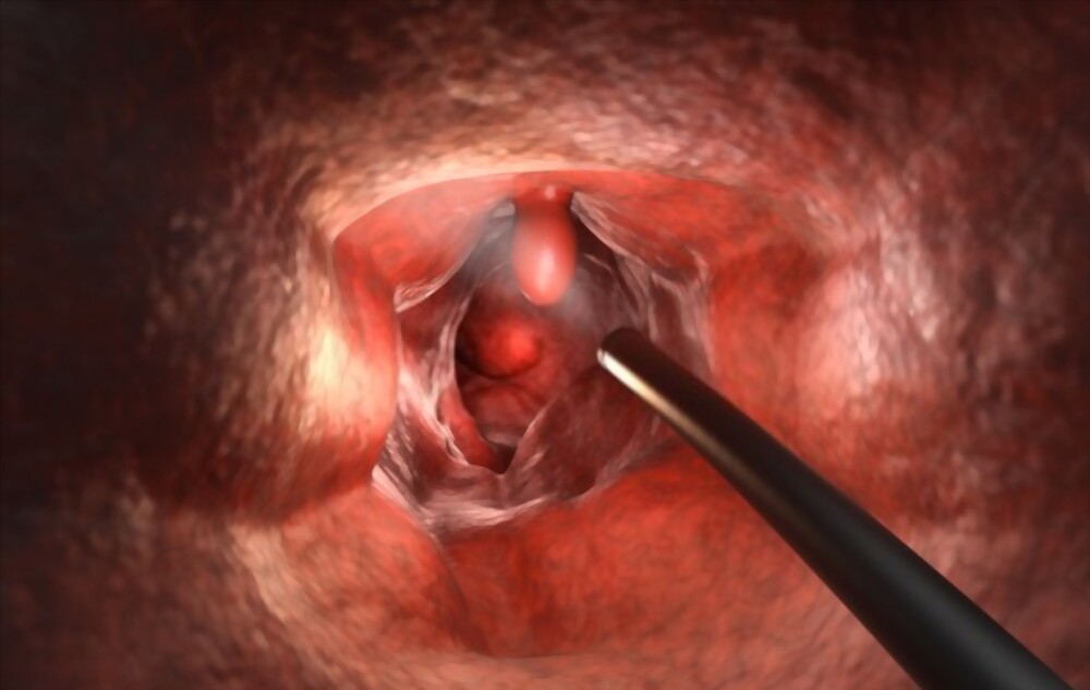 endoscopy for colon cancer